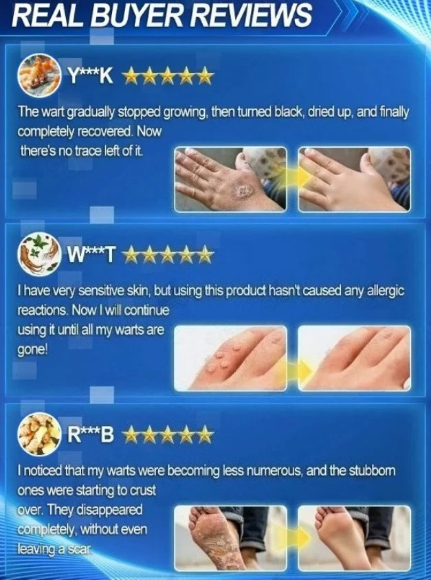 Blue Light Wart Remover Tool Painless Wart Removal Improve Skin Condition Better Life