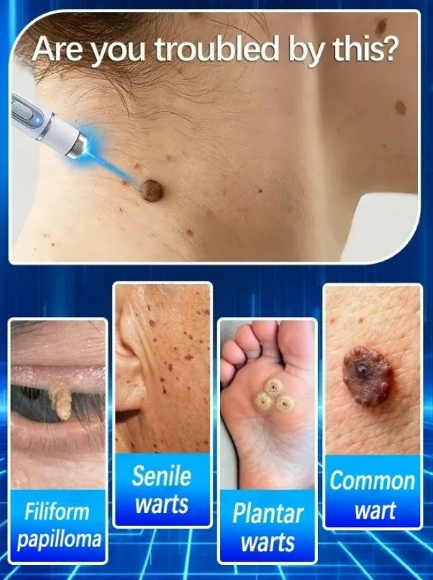Blue Light Wart Remover Tool Painless Wart Removal Improve Skin Condition Better Life
