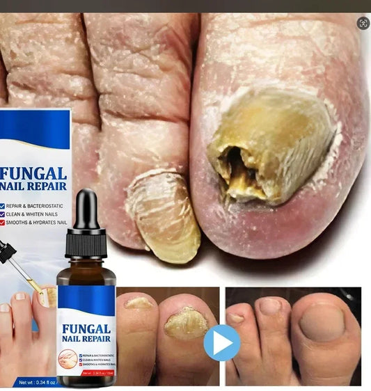 Nail Fungals Renewal Nail Repair Liquid for Discolored Thickened Crumbled Nails Nail Fungals for Discolored Broken Cracked xxs36