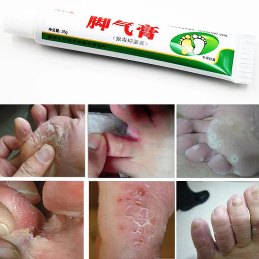 New Arrival Cream Care for Feet Rotten Peeling Itching Blisters Foot Corn Odor Sweat Antibacterial Ointment Pain removal Plaster