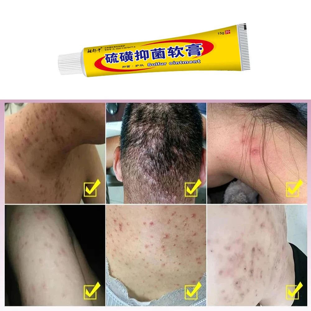 Sulfur Antibacterial Cream Soap Spray Set Psoriasis Eczema Anti-itch Relief Rash Urticaria Desquamation Ointment Body Skin Care