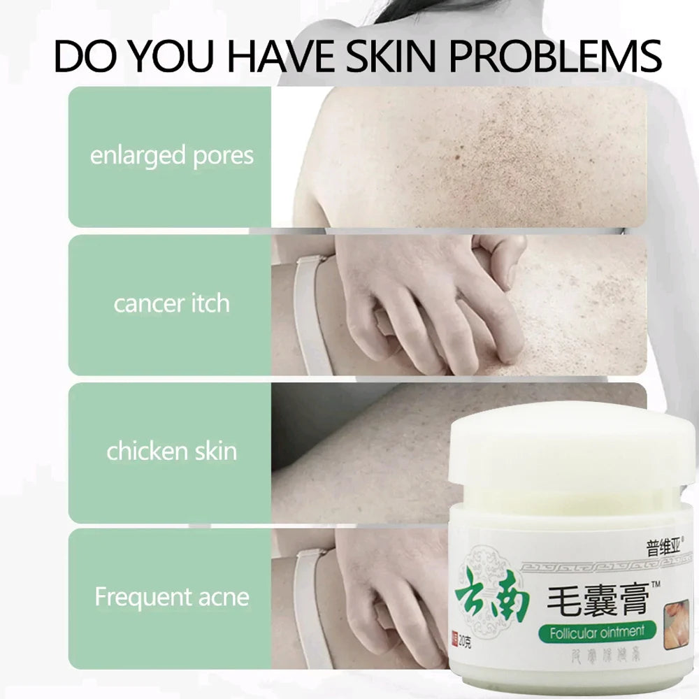 Body Acne Removal Cream Treatment Face Butt Back Acne Marks Smooth Repair Chicken Skin Cream Moisturizing Whitening Skin Care