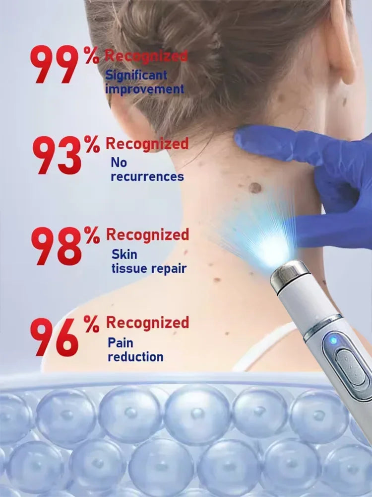 Blue Light Wart Remover Tool Painless Wart Removal Improve Skin Condition Better Life