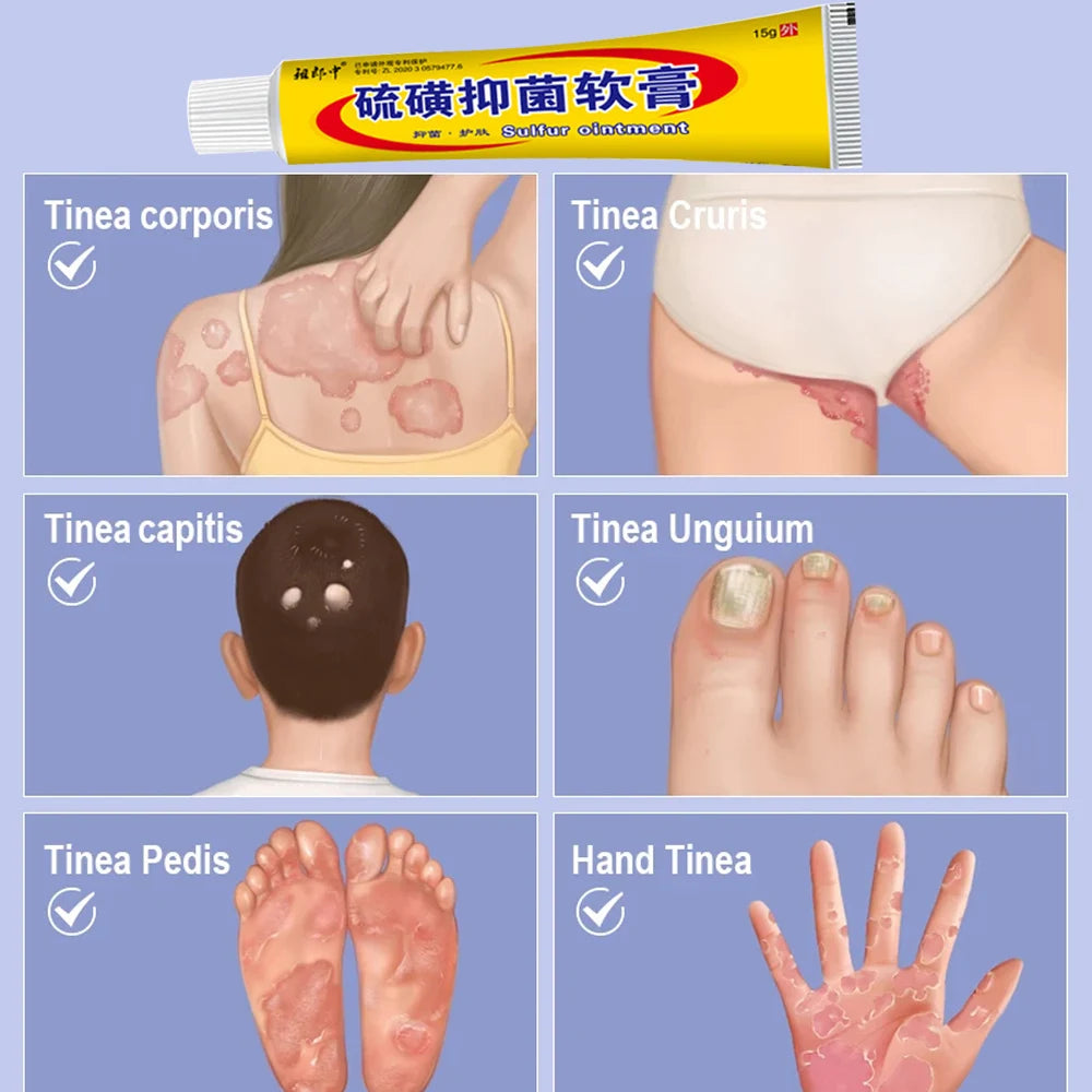 Sulfur Antibacterial Cream Soap Spray Set Psoriasis Eczema Anti-itch Relief Rash Urticaria Desquamation Ointment Body Skin Care