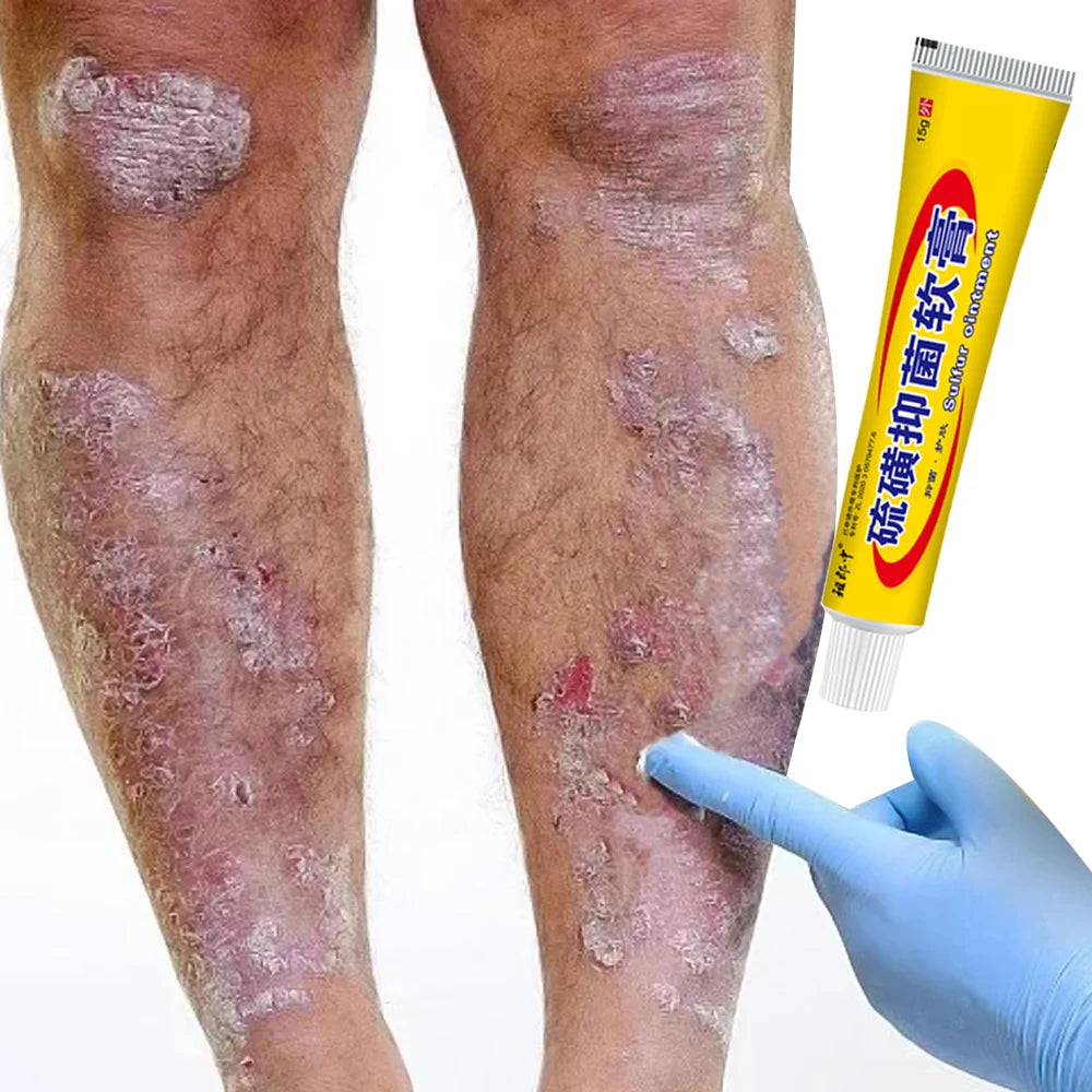Sulfur Antibacterial Cream Soap Spray Set Psoriasis Eczema Anti-itch Relief Rash Urticaria Desquamation Ointment Body Skin Care
