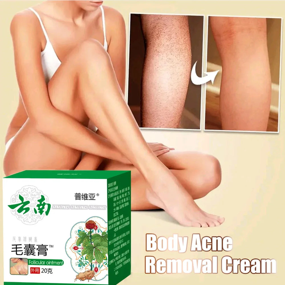 Body Acne Removal Cream Treatment Face Butt Back Acne Marks Smooth Repair Chicken Skin Cream Moisturizing Whitening Skin Care